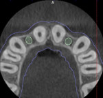 Fig 3. CBCT imaging revealed marginal bone thickness of approximately 4.5 mm in the gaps of the teeth.