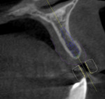 Fig 4. CBCT imaging also revealed apical thinning.