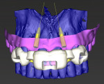 Fig 6. Positioning of the implants.