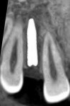 Fig 12. Positioning of implants confirmed using CBCT.