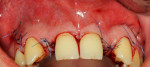 Fig 11. Flap repositioning and wound closure.