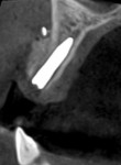 Fig 13. Positioning of implants confirmed using CBCT.