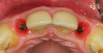 Fig 15. Good gingiva formation and profiling 6 weeks after temporary restoration.