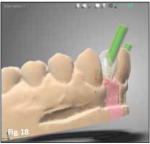 Fig 18. Restorations designed with Straumann CARES® Visual Software 10.1.