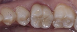 Fig 2. The zirconia crown shown in Figure 1 with 0.3 mm cut-back and a 0.3 mm layering of porcelain. Note the excellent esthetic match to the adjacent teeth with significantly improved translucency over the purely monolithic form.