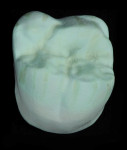 Fig 7. Monolithic molar crown after dipping it in pigment and then custom colorizing it with one of the “low visual pigment” systems. Note it is very difficult to judge special characterizations.