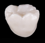 Fig 14. Monolithic molar crown fired 30°C higher than the ideal temperature determined to develop optimal translucency. Note the slight increased opacity relative to Figure 13.