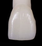 Fig 16. Anterior monolithic crown that was glazed on the right half and glazed and polished on the left half. Glazing and polishing provided a more natural tooth surface appearance.