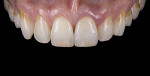 Fig 22 through Fig 25. Images of complete monolithic cubic zirconia crowns (tooth No. 9).