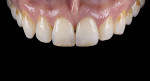Fig 22 through Fig 25. Images of complete monolithic cubic zirconia crowns (tooth No. 9).