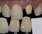 Fig 21. Prepared tooth No. 9 while taking shade demonstrating normal color substrate.