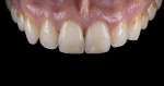 Fig 26. Image of complete monolithic lithium-disilicate crown (tooth No. 9) that served as a control.