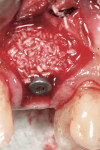 Figure 7  A slowly resorbing anorganic bone graft material mixed 25% with CaS was added facially to augment the deficient bony wall and to help in re-establishing a buccal convexity to the site. The bone graft will protect the thin buccal plate of bo