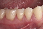 Fig 1. Buccal view (mirror image) of teeth Nos. 19 through 21 with NCCLs.