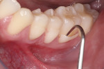 Fig 9. The inlays can be easily lifted from the preparation during try-in, and additional extraoral finishing and polishing can be obtained until optimal marginal fit is obtained.