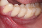 Fig 4. Composite is inserted on the nontreated preparations in excess to capture a clear gingival margin and to allow its removal without breaking the fragile, thin margins of the composite in its desired final contour.