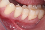 Fig 8. The inlays are tried intraorally. Note the superb marginal adaptation, particularly in the gingival margins, and the health of the gingival tissues, which are typically injured during intraoral finishing and polishing procedures.