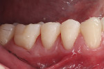 Fig 14. Buccal view (mirror image) of the bonded direct-indirect composite inlays. Note the somewhat irregular occlusal margins in contrast to the excellent marginal adaptation at the gingival margins.