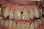 Fig 1. Initial presentation. Tooth No. 9 presented with extrusion, severe recession, lack of attached keratinized tissue.