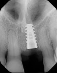 Fig 5. Periapical radiograph of immediate implant. Note contact of the implant with the mesial wall of the socket but not with the distal wall. Perforation of the nasal floor with apex suggested.