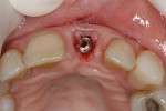 Fig 4. Immediate implant placed in socket. A horizontal defect dimension evident facial to the implant.
