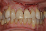 Fig 10. ETPC in place. Gingiva stabilized coronally with sutures.