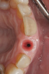 Fig 13. Occlusal view of peri-implant tissue. The natural ridge contour was reestablished.