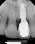 Fig  15. Periapical radiograph at 1.5 years postoperative. stable bone levels demonstrated.