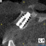 Fig 6. Sagittal cross section of immediate implant in place. Note the horizontal defect dimension buccal to the implant. A portion of the implant apex has breached the nasal floor, which may have contributed to increased insertion torque.