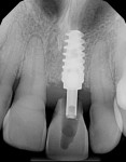 Fig 12. Periapical radiograph at 3 months. Bone healing around the implant and bone fill of the socket evident.