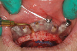 (6.) Foundation guide struts removed and Piezosurgery saw creating maxillary ostectomy.