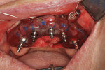 (7.) Maxillary surgical guide snapped on foundation guide and implants with implant mounts torqued to place with flat surface aligned with blue indicator lines.