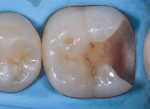 (3.) Caries removal endpoint and peripheral seal zone development.