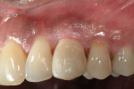 Figure 14  Postoperative check by the periodontist at 4 weeks after the provisional placement by the restorative dentist. The soft tissue health looked excellent. Further interproximal and mid-buccal soft tissue support has been recommended to help i