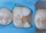 (8.) Cementation appointment. Tooth is conditioned by air abrasion and phosphoric acid etching for maximum bond strength. An indirect or a chairside fabricated Inlay restoration provides maximum stress reduction and maximum bond strength.