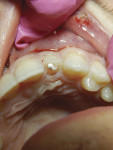 (3.) The dental pulp polyp has been removed, hemostasis obtained, and TheraCal LC placed.