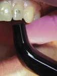 (4.) Composite strip crown providing protection and a seal against microleakage. The temporary crown covers all exposed dentin and palatal root surface.
