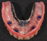 (5.) View of the maxillary denture following pick-up of the Denture Attachment Housings and replacement with blue Low Retention Inserts.