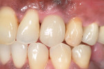 Figure 23  Completed crown on tooth No. 11. Note restored soft and hard tissue profiles on the facial aspect. Compare with Figure 3. The final crown was duplicated from the provisional, which acted as the final “blueprint” of the necessary crown