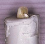 Figure 4  Incisal view of the screw-retained provisional restoration affixed to the analog within the model stone.