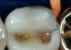 Fig 10. SEMs: lithium disilicate (upper left); zirconia (upper right); enamel (lower left); dentin (lower right).
