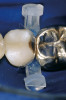 Fig 13. Two different teeth with similar color (A2 shade guide in center).