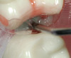 Fig 21. Standard deviation, central incisors.