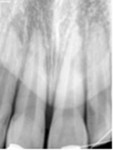 (2.) Typical radiographic example of external inflammatory root resorption.
