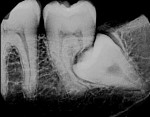 (3.) Typical radiographic example of pressure resorption.