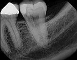 (4.) Typical radiographic example of invasive cervical root resorption.