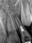 (5.) While the majority of ICRR lesions appear near the cementoenamel junction, this case demonstrates a case of ICRR noted more apically due to eruption patterns causing the periodontal attachment to be placed apically in a patient treated with a regenerative endodontic procedure on a lateral incisor following an avulsive injury. No pathology was noted immediately following the procedure; however, it is present at the one year follow-up at the level of the junctional epithelium of the adjacent erupting permanent canine.