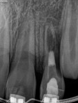 (6.) While the majority of ICRR lesions appear near the cementoenamel junction, this case demonstrates a case of ICRR noted more apically due to eruption patterns causing the periodontal attachment to be placed apically in a patient treated with a regenerative endodontic procedure on a lateral incisor following an avulsive injury. No pathology was noted immediately following the procedure; however, it is present at the one year follow-up at the level of the junctional epithelium of the adjacent erupting permanent canine.