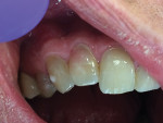 (7.) A case of ICRR in tooth #10 presenting with pink discoloration noted in the cervical portion of the tooth.
