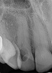 (8.) Confirmed to be ICRR on periapical image.